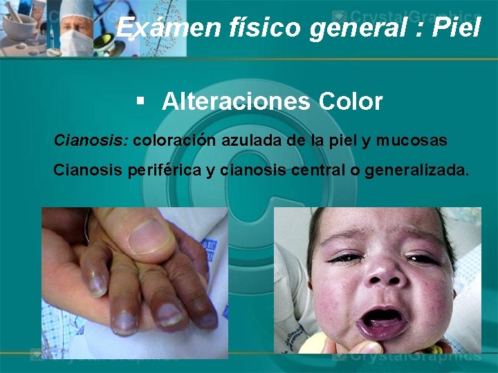 Exámen físico general : Piel § Alteraciones Color Cianosis: coloración azulada de la piel