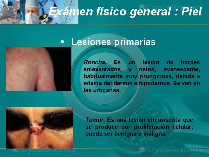 Exámen físico general : Piel § Lesiones primarias Roncha. Es un lesión de bordes