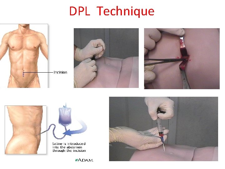 DPL Technique 