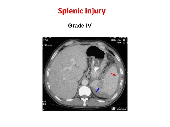 Splenic injury Grade IV 