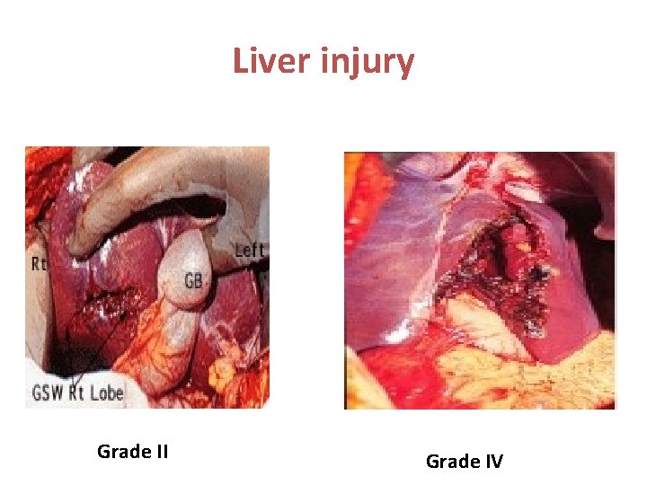 Liver injury Grade II Grade IV 