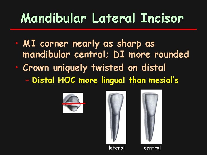 Mandibular Lateral Incisor • MI corner nearly as sharp as mandibular central; DI more