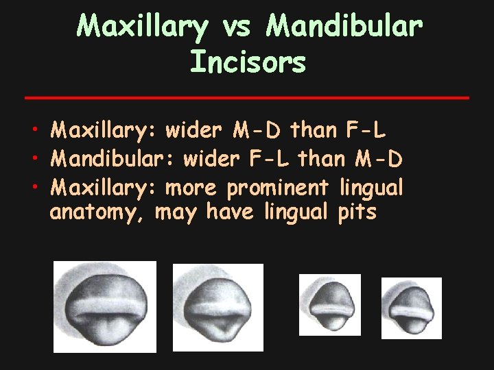 Maxillary vs Mandibular Incisors • Maxillary: wider M-D than F-L • Mandibular: wider F-L