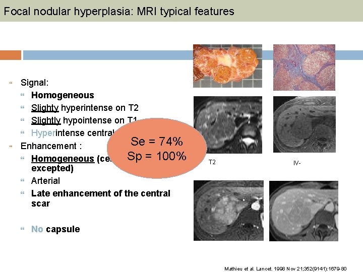 Focal nodular hyperplasia: MRI typical features Signal: Homogeneous Slighty hyperintense on T 2 Slightly