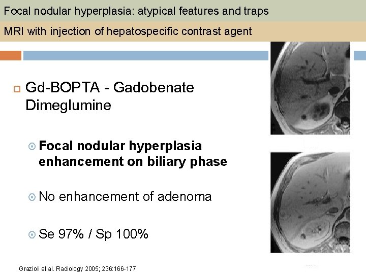Focal nodular hyperplasia: atypical features and traps MRI with injection of hepatospecific contrast agent