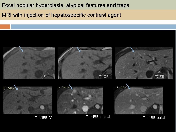 Focal nodular hyperplasia: atypical features and traps MRI with injection of hepatospecific contrast agent