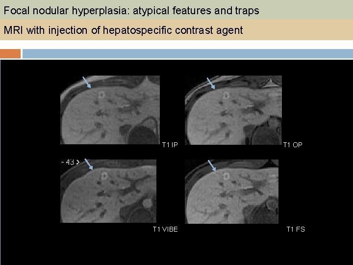 Focal nodular hyperplasia: atypical features and traps MRI with injection of hepatospecific contrast agent
