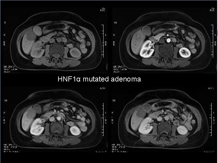 HNF 1α mutated adenoma 