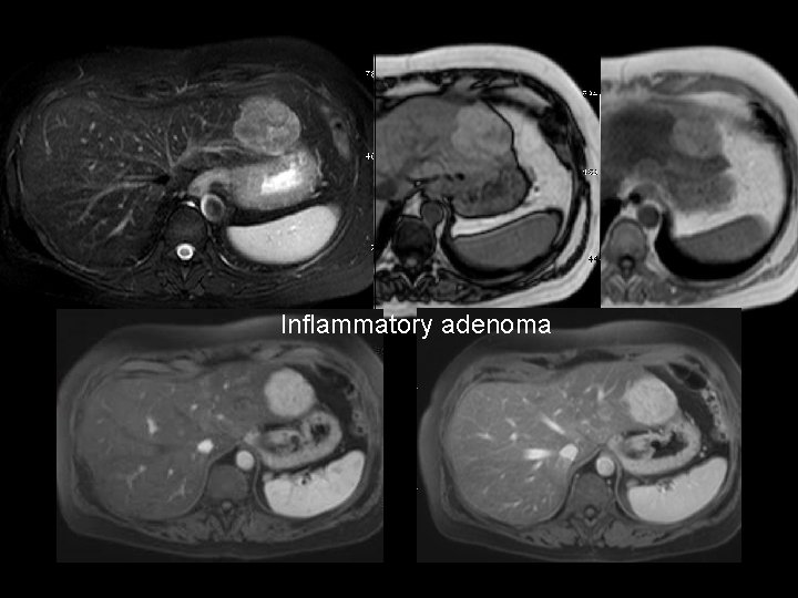 Inflammatory adenoma 