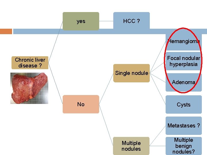 yes HCC ? Hemangioma Focal nodular hyperplasia Chronic liver disease ? Single nodule Adenoma