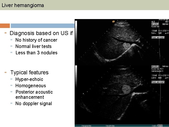 Liver hemangioma Diagnosis based on US if No history of cancer Normal liver tests
