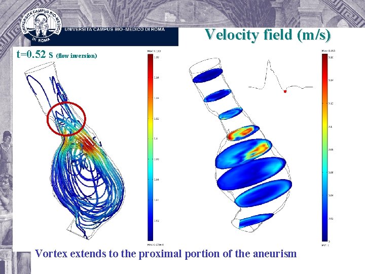 Velocity field (m/s) t=0. 52 s (flow inversion) Vortex extends to the proximal portion