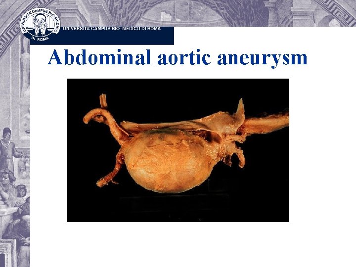 Abdominal aortic aneurysm 