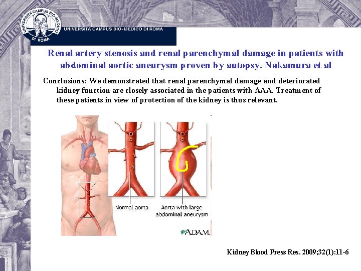 Renal artery stenosis and renal parenchymal damage in patients with abdominal aortic aneurysm proven