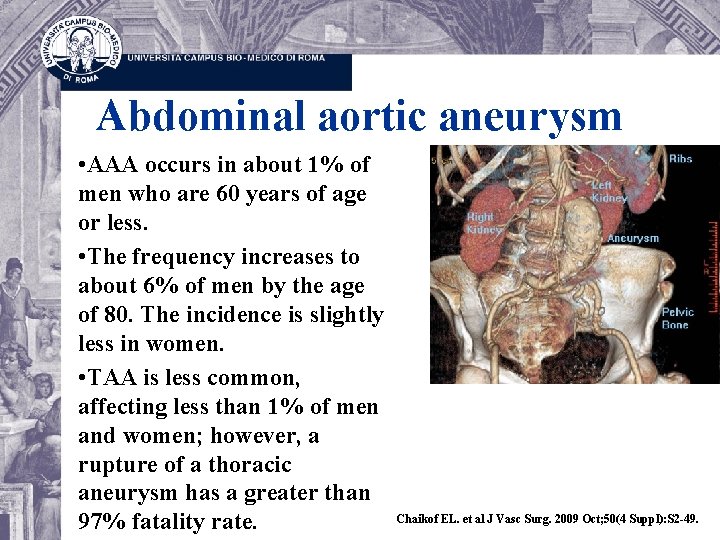 Abdominal aortic aneurysm • AAA occurs in about 1% of men who are 60