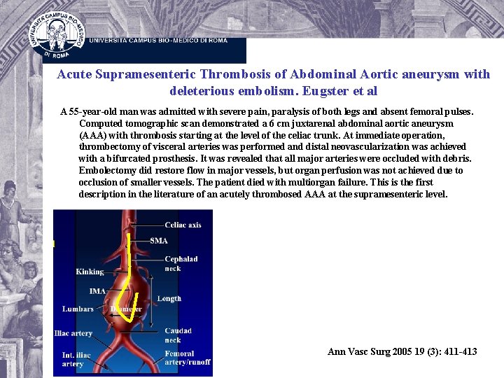 Acute Supramesenteric Thrombosis of Abdominal Aortic aneurysm with deleterious embolism. Eugster et al A