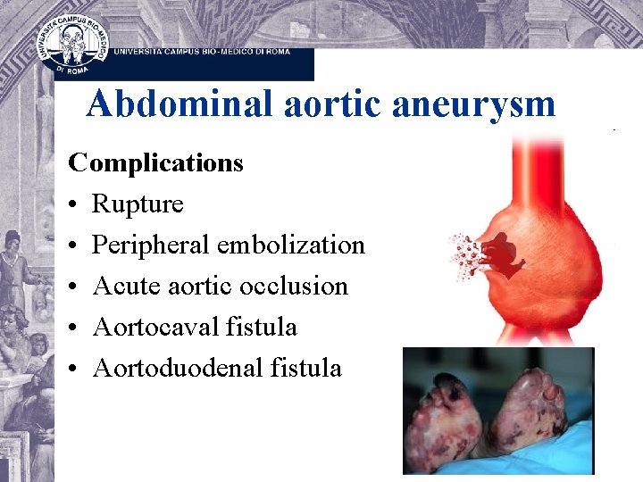 Abdominal aortic aneurysm Complications • Rupture • Peripheral embolization • Acute aortic occlusion •