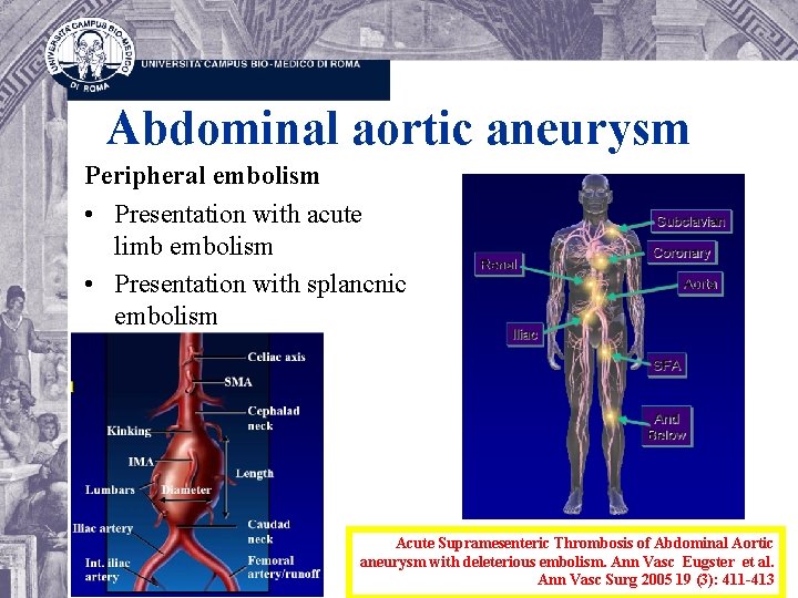 Abdominal aortic aneurysm Peripheral embolism • Presentation with acute limb embolism • Presentation with