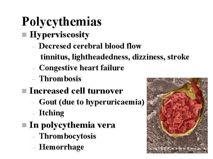 Polycythemias n Hyperviscosity – – – n Increased cell turnover – – n Decresed