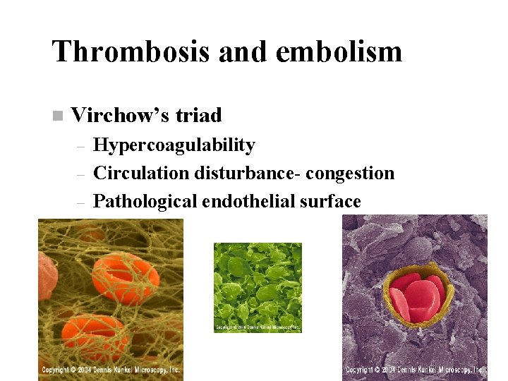 Thrombosis and embolism n Virchow’s triad – – – Hypercoagulability Circulation disturbance- congestion Pathological