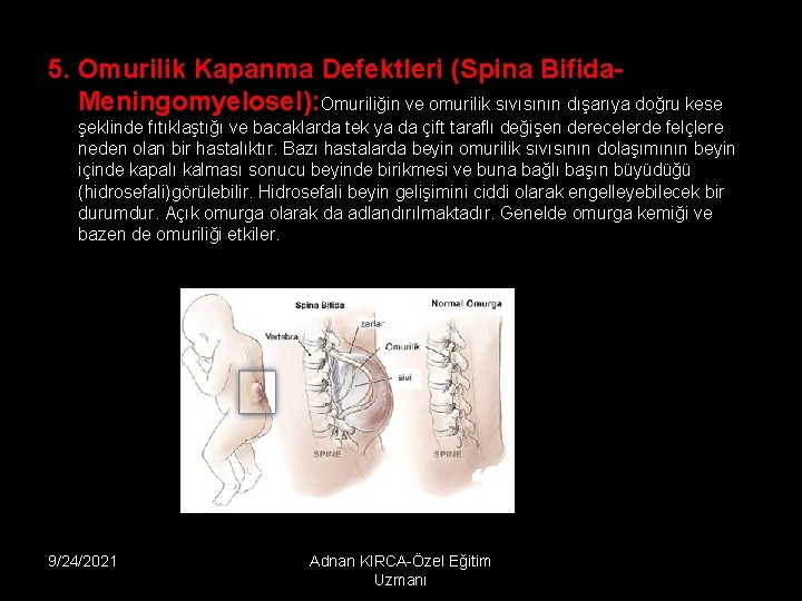 5. Omurilik Kapanma Defektleri (Spina Bifida. Meningomyelosel): Omuriliğin ve omurilik sıvısının dışarıya doğru kese
