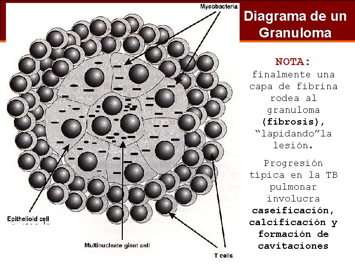 Diagrama de un Granuloma NOTA: finalmente una capa de fibrina rodea al granuloma (fibrosis),
