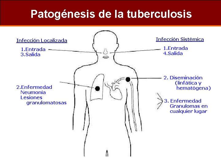 Patogénesis de la tuberculosis 
