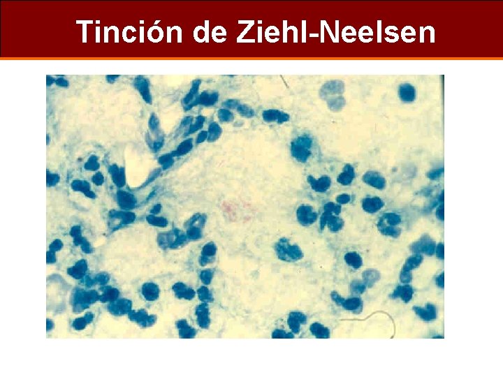 Tinción de Ziehl-Neelsen 