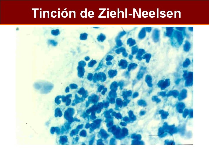 Tinción de Ziehl-Neelsen 