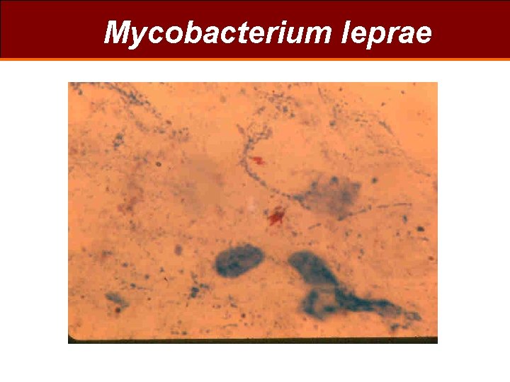 Mycobacterium leprae 