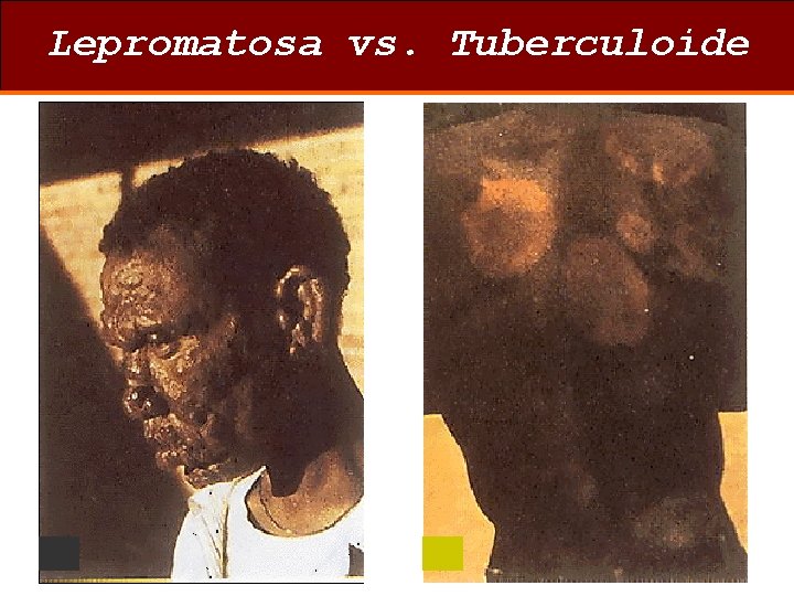Lepromatosa vs. Tuberculoide 