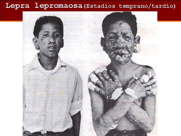 Lepra lepromaosa(Estadíos temprano/tardío) 