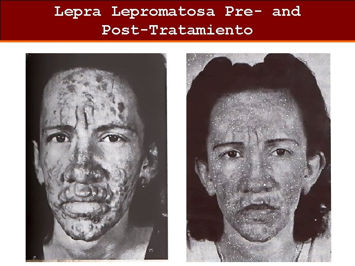 Lepra Lepromatosa Pre- and Post-Tratamiento 