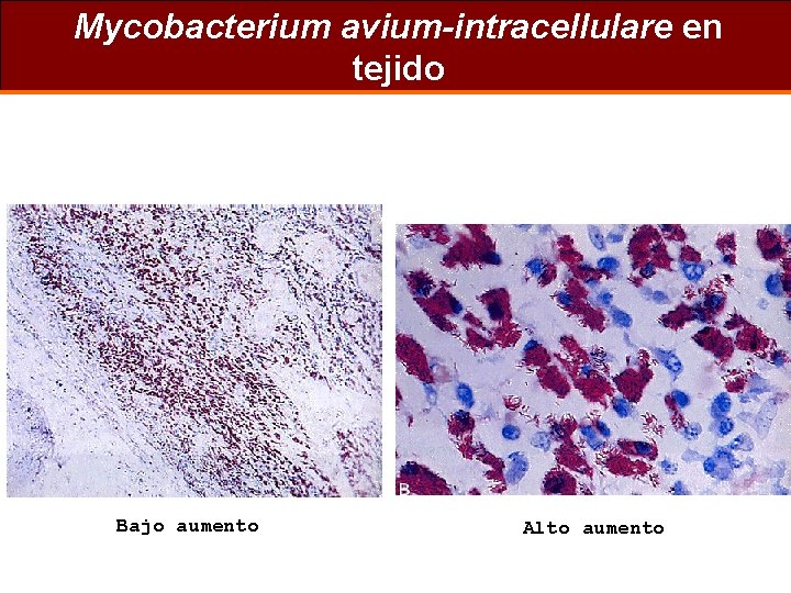 Mycobacterium avium-intracellulare en tejido Bajo aumento Alto aumento 
