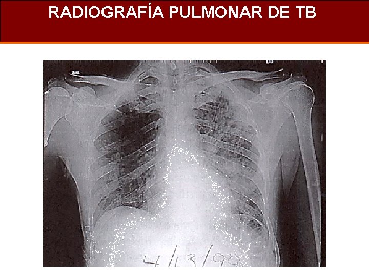RADIOGRAFÍA PULMONAR DE TB 