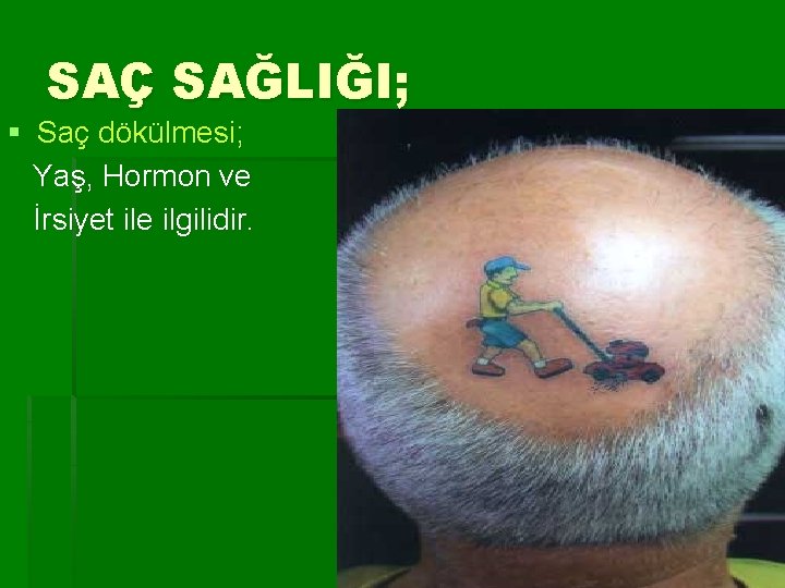 SAÇ SAĞLIĞI; § Saç dökülmesi; Yaş, Hormon ve İrsiyet ile ilgilidir. 