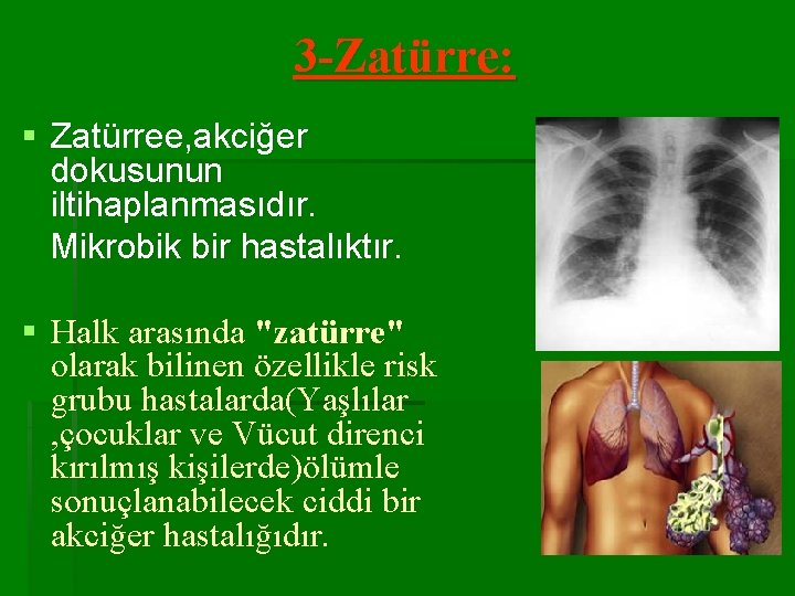 3 -Zatürre: § Zatürree, akciğer dokusunun iltihaplanmasıdır. Mikrobik bir hastalıktır. § Halk arasında "zatürre"