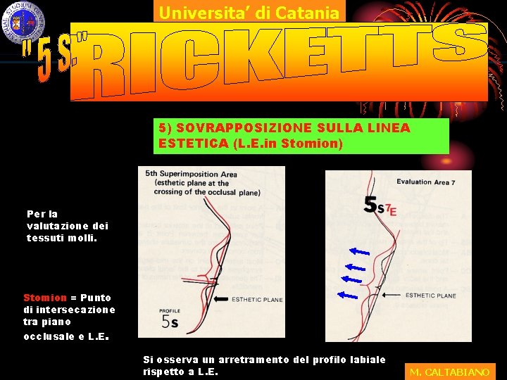 Universita’ di Catania 5) SOVRAPPOSIZIONE SULLA LINEA ESTETICA (L. E. in Stomion) Per la