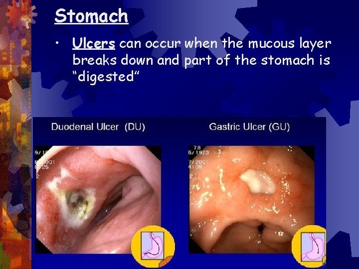 Stomach • Ulcers can occur when the mucous layer breaks down and part of