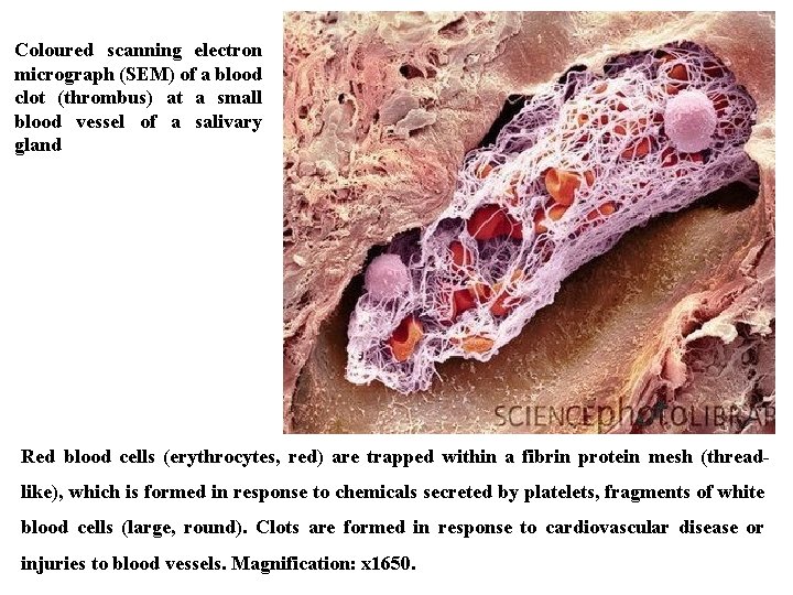 Coloured scanning electron micrograph (SEM) of a blood clot (thrombus) at a small blood