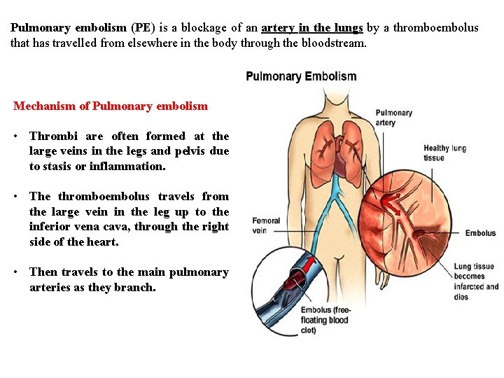 Pulmonary embolism (PE) is a blockage of an artery in the lungs by a