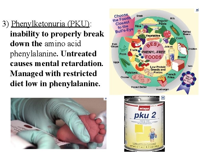 3) Phenylketonuria (PKU): inability to properly break down the amino acid phenylalanine. Untreated causes