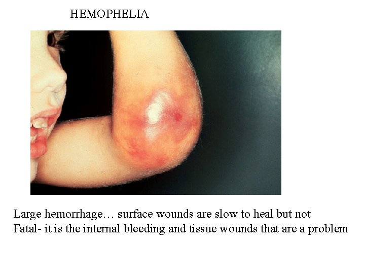 HEMOPHELIA Large hemorrhage… surface wounds are slow to heal but not Fatal- it is