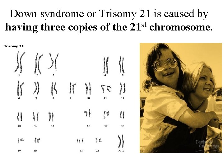 Down syndrome or Trisomy 21 is caused by having three copies of the 21