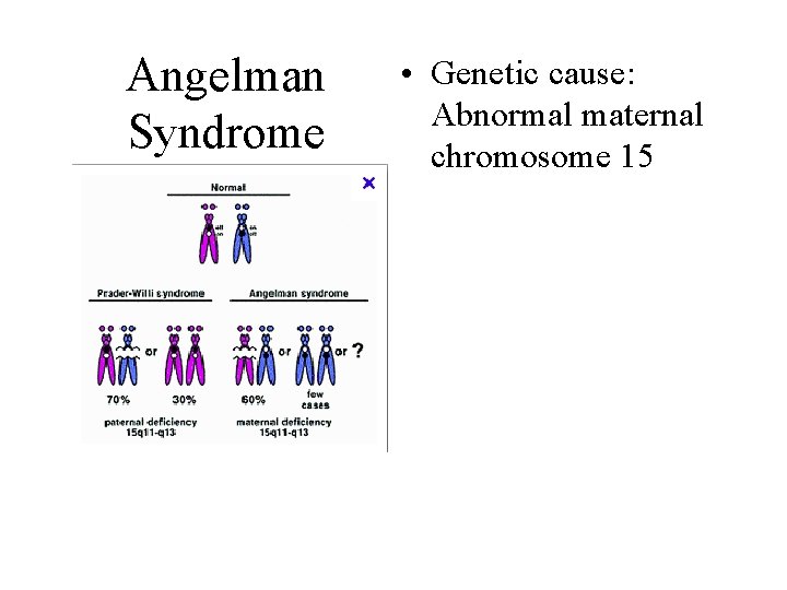 Angelman Syndrome • Genetic cause: Abnormal maternal chromosome 15 