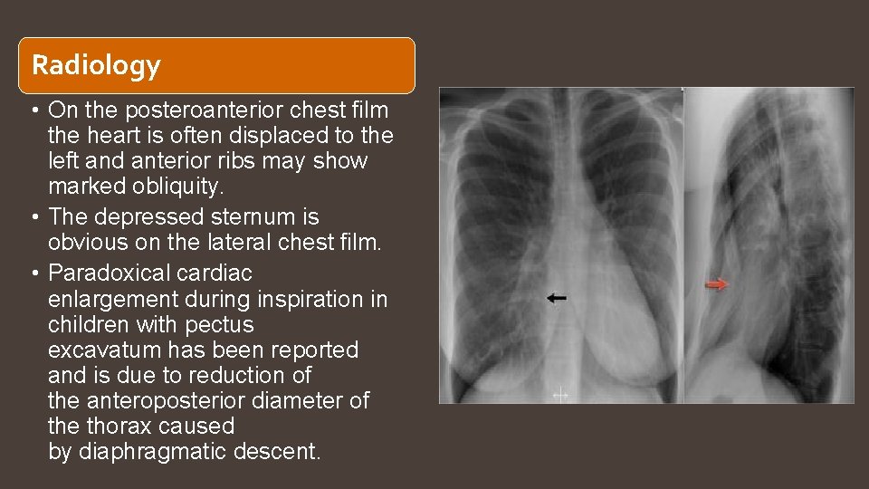 Radiology • On the posteroanterior chest film the heart is often displaced to the