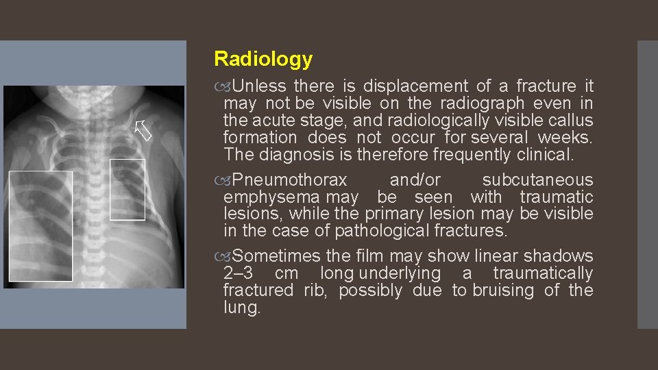 Radiology Unless there is displacement of a fracture it may not be visible on
