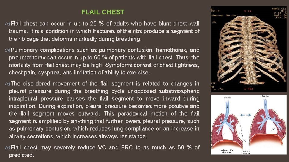 FLAIL CHEST Flail chest can occur in up to 25 % of adults who