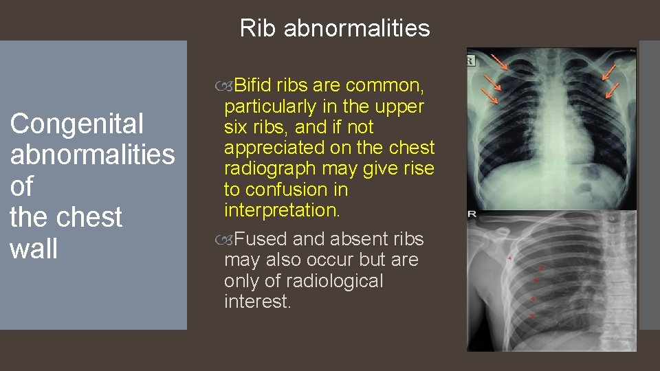 Rib abnormalities Congenital abnormalities of the chest wall Bifid ribs are common, particularly in