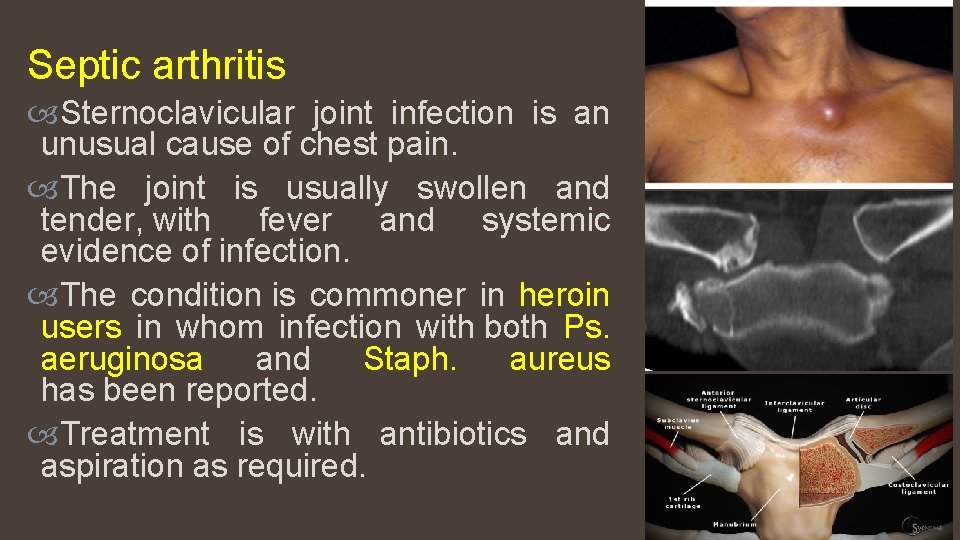 Septic arthritis Sternoclavicular joint infection is an unusual cause of chest pain. The joint